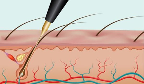 Thermolyse technique